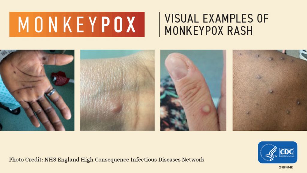 monkeypox rash examples