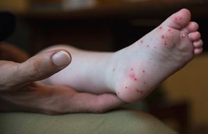 parent holding child's foot covered in small red blisters